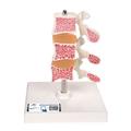 3B Scientific Deluxe Osteoporosis Model - w/ 3B Smart Anatomy 1000153